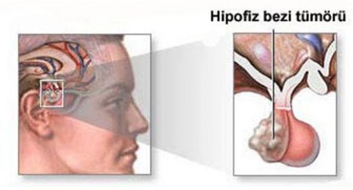 hiperprolaktinemi, süt hormonu fazlalığı hiperprolaktinemi, süt hormonu fazlalığı
