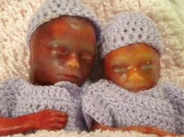 intrauterin-fetal-olum--anne-karninda-bebek-olumu- intrauterin-fetal-olum--anne-karninda-bebek-olumu-
